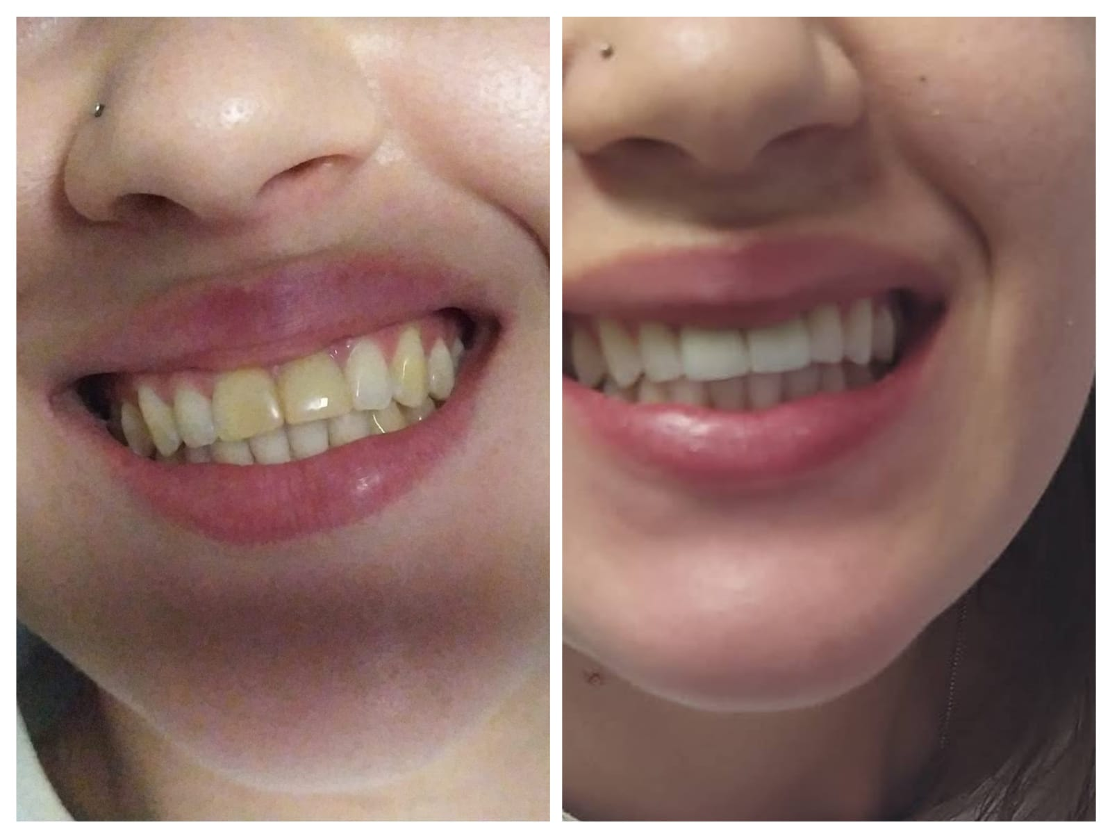 Clareamento Dental — antes e depois